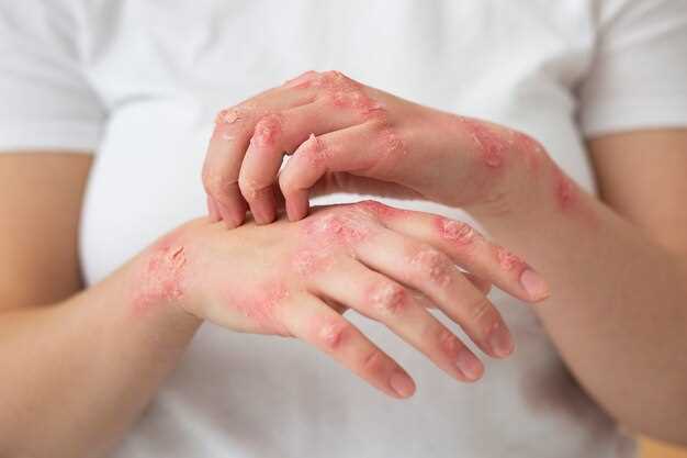 Контактный дерматит: виды, симптомы, диагностика, лечение и профилактика